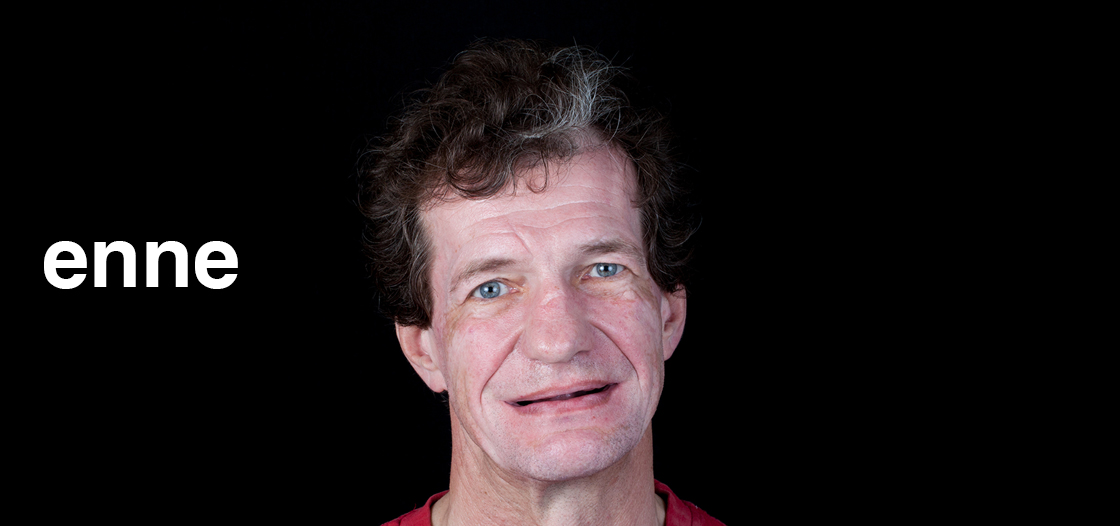 Case 2 - Implantatsioon. Kompleksne naeratuse taastamine 6 Meerhof Dental Center Case 2 – Implantatsioon. Kompleksne naeratuse taastamine - https://staging.meerhofdk.ee/case-2-implantatsioon-kompleksne-naeratuse-taastamine/